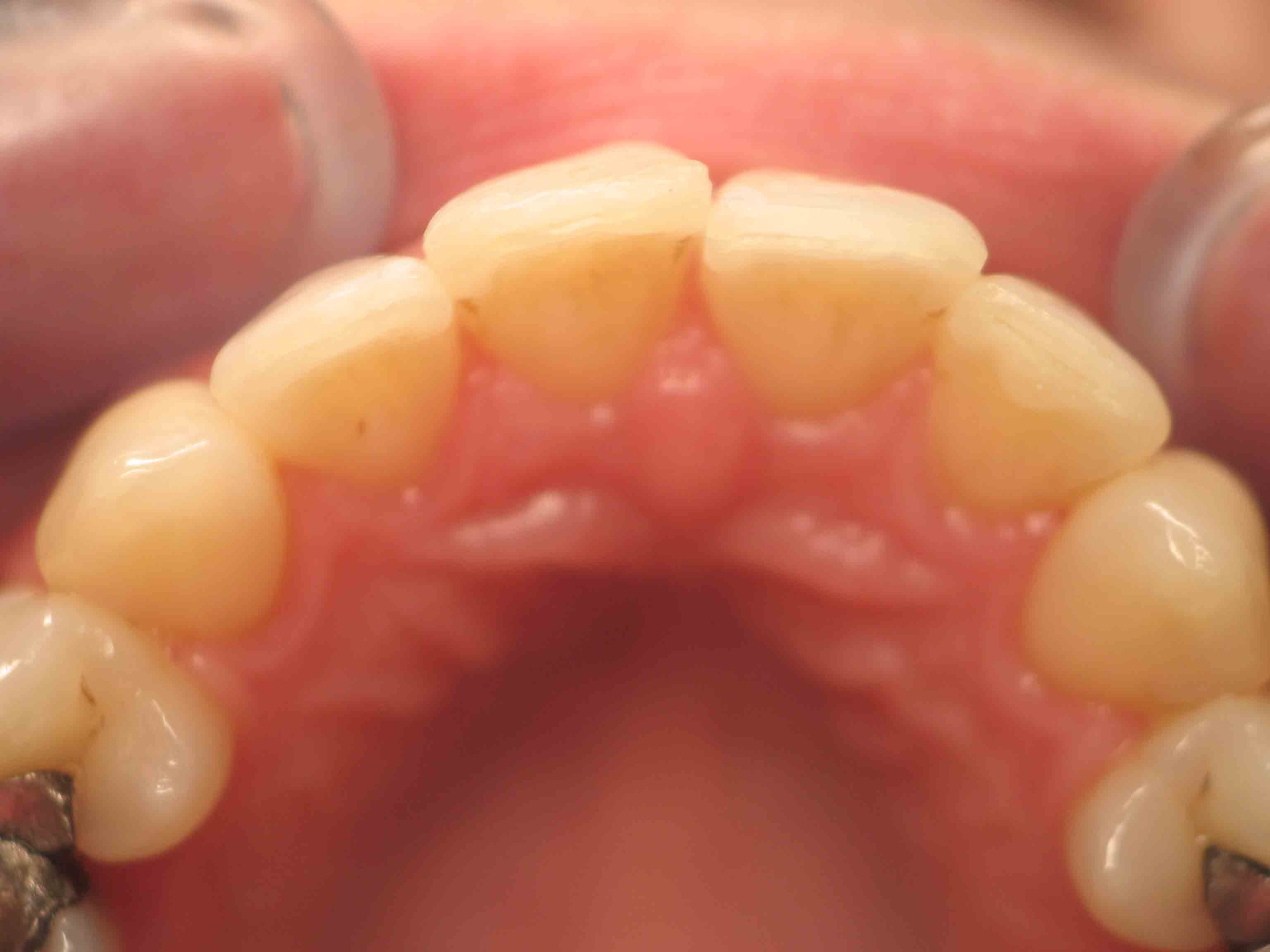 After orthodontic treatment